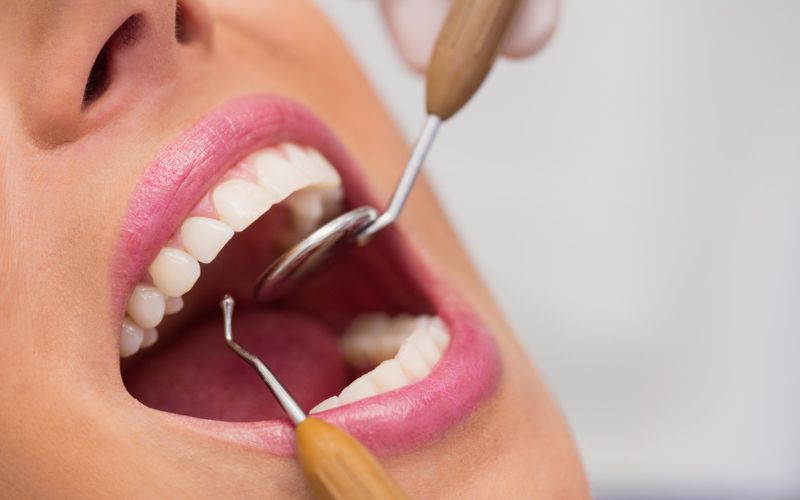 Implantes Dentários
